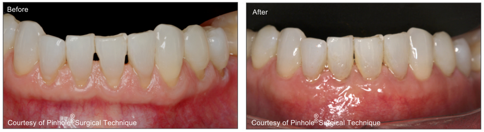Before and After: Pinhole Surgical Technique for Receeding Gums