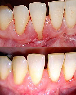 Gum Grafts: before and after